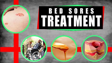 Bed Sores Treatment: How to Treat Bed Sores at Home – Top 5 Remedies ...