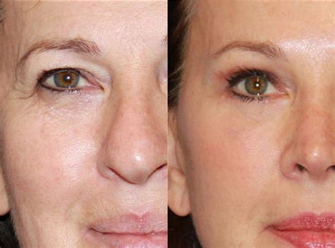 Eyelid Surgery - Upper & Lower, Blepharoplasty Surgery, Recovery