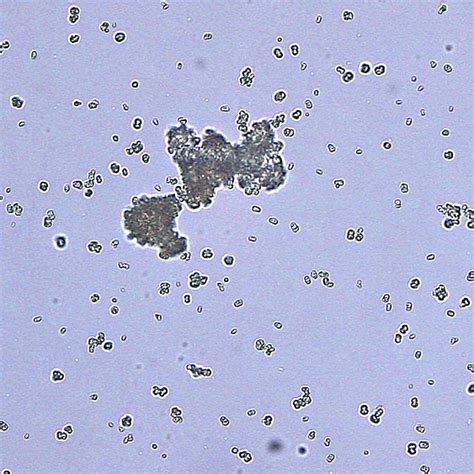 Ammonium biurate (urate) or xanthine crystals in urine from an English ...