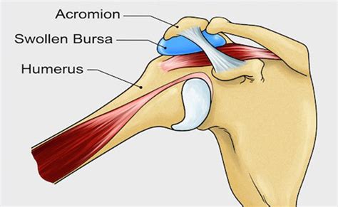 What is Shoulder Bursitis? - Broadmeadow Physiotherapy Newcastle