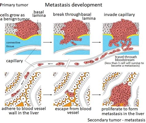 Metastases in cervical cancer patients | BOOKIMED