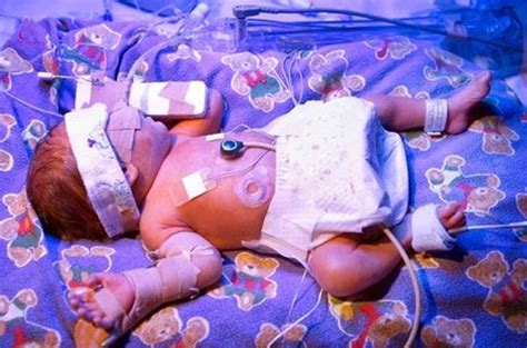 Jaundice In Baby - Symptoms, Causes & Treatment | Pregnancy in Singapore