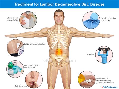 Types of Degenerative Disc Disease & Its Symptoms, Treatment ...