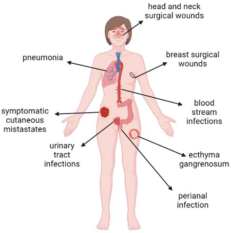 Pseudomonas Aeruginosa Disease Caused - Carpet Vidalondon