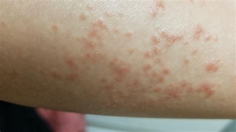 HELPp! I have this red bumpy acne rash on my forearm that sting when ...