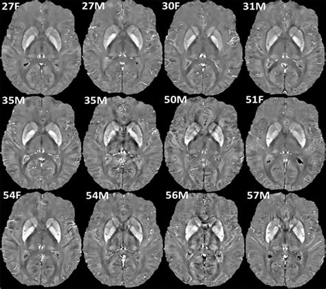 Axial cuts through the corpus striatum illustrating visually tractable ...