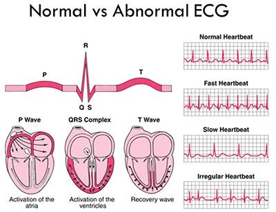 What is an Electrocardiogram? - Cardiovascular Institute of the Shoals