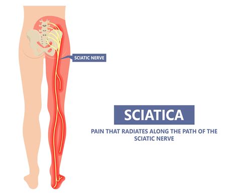 Best Sciatica Treatment in Cary, NC | Shiva Physical Therapy