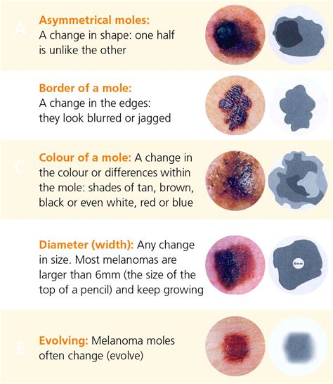 Symptoms And Diagnosis Of Melanoma Irish Cancer Society | Free Download ...