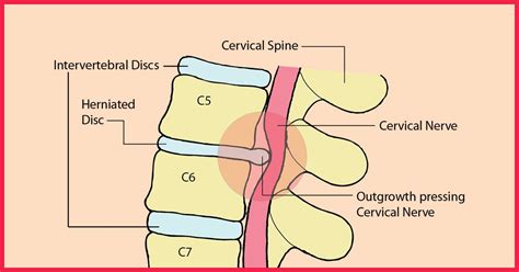 Yoga Stretches For Herniated Disc - YogaWalls