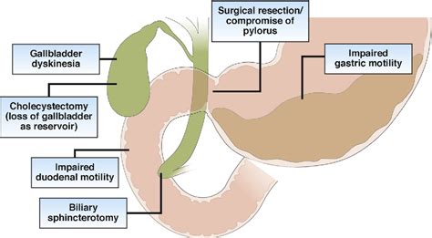 Figure 1 from New Causes for the Old Problem of Bile Reflux Gastritis ...