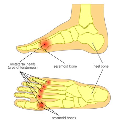 Metatarsal pain: Metatarsalgia - Marie Whitfield Podiatry | Ball of ...