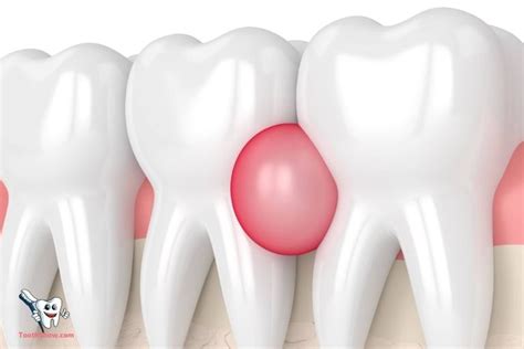 What Is An Abscess Tooth Pics? Symptoms And Treatments!