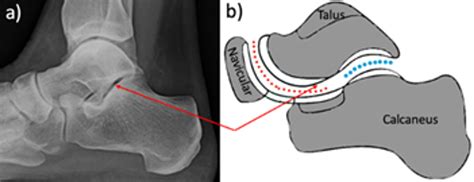 Cureus | Arthroereisis: Treatment of Pes Planus