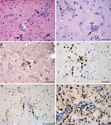 Microscopy of the brain tissue. (a) Shows an increased number of ...