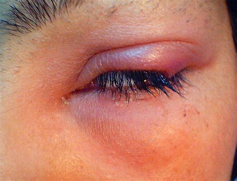 Eye Stye - Pictures, Treatment, Symptoms, Causes, Contagious