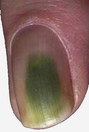 Everything you should know about Green Nail Syndrome