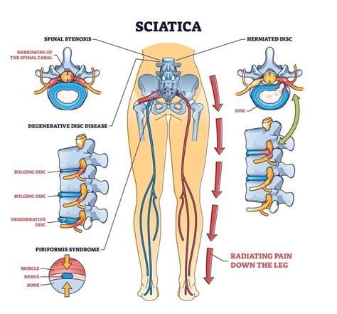 Managing Chronic Sciatica Symptoms: A Multidisciplinary Plan - El Paso ...