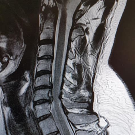 My c5 c6 nerve root compression : r/XRayPorn