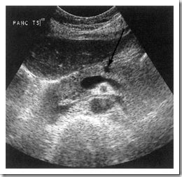 Ultrasound images of Cysts pancreas - Radiology Imaging