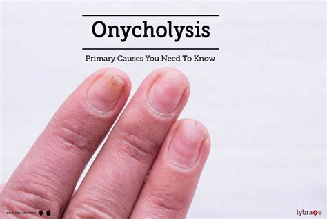 Onycholysis: Primary Causes You Need To Know! - By Dr. Mohna | Lybrate