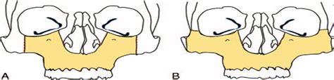 Mid-Face Degloving: An Alternate Approach to Extended Osteot ...