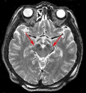 Brain and Spines: Parkinson's Disease