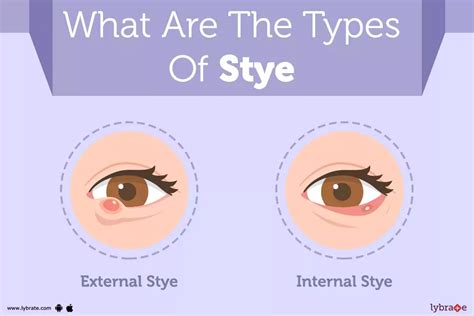 Stye: Causes, Symptoms, Treatment And Cost