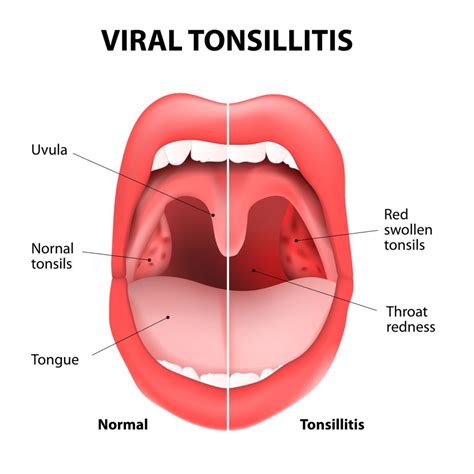 Bacterial Tonsillitis Symptoms In Adults