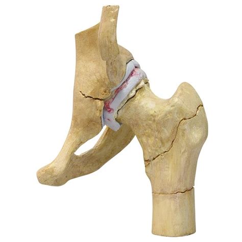 Degenerative Bone Diseases of the Hip Model (4 stages) 1320 | Hip Diagnosis