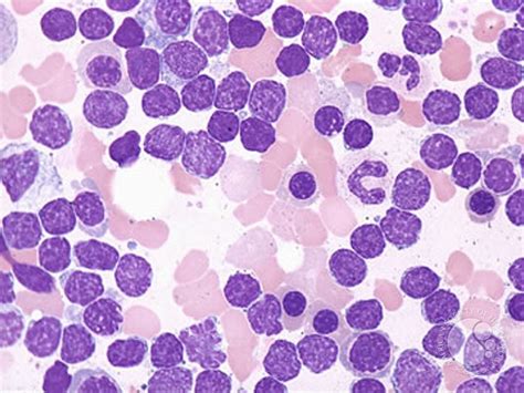 Chronic Lymphocytic Leukemia - 3.