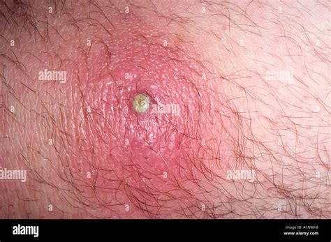 methicillin resistant staph aureus skin infection in a 26 year old male ...