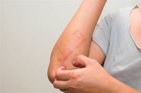 Eczema | Q Dermatology