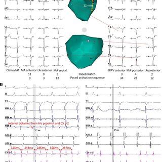 (Patient no 5): Comparison of the P wave morphology during FAT and ...