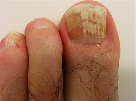 Fungus on both feet, left and right – Toenail Fungus