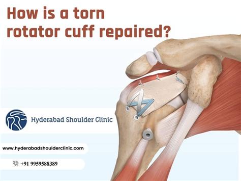 Rotator Cuff Injury Including Rotator Cuff Tear, Rotator Cuff Bursitis ...