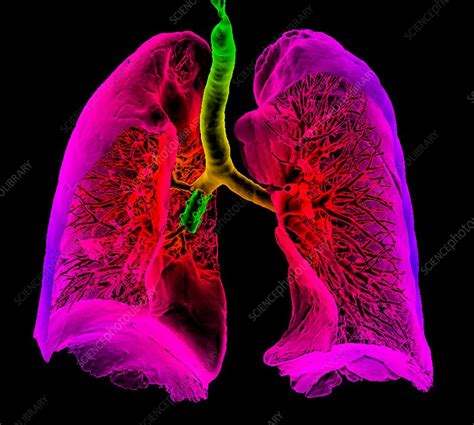 Bronchial stent, 3D CT scan - Stock Image - C034/5281 - Science Photo ...