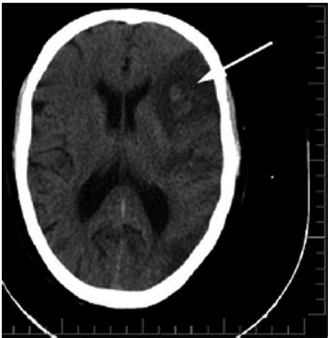 Brain CT scan at admission. Figure 2. Control CT Scan (ischemic stroke ...