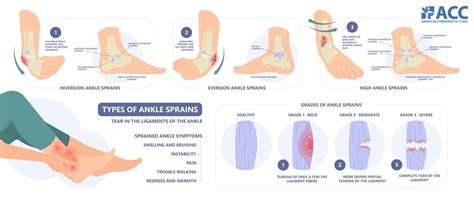 Ankle pain: Causes and Treatments | ACC