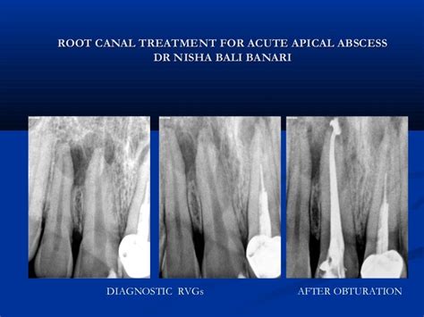 ACUTE APICAL ABSCESS