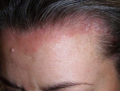 Mild scalp psoriasis pictures | Symptoms and pictures