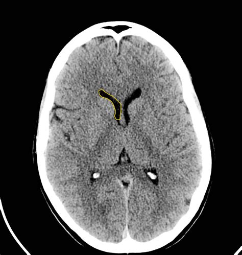 Ct Scan Brain Anatomy - Anatomy Reading Source