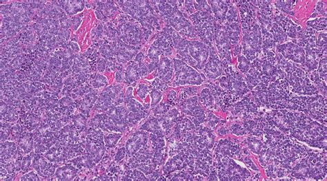 Ewing Sarcoma Histology