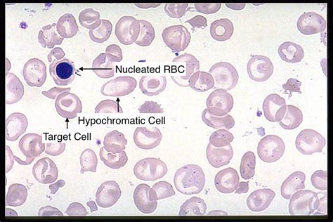 β-Thalassemia – Stepwards