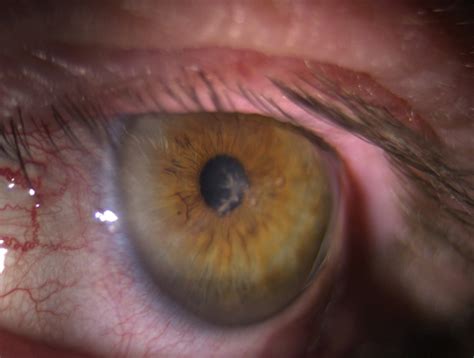 Herpes Simplex Keratitis: Managing the Masquerader