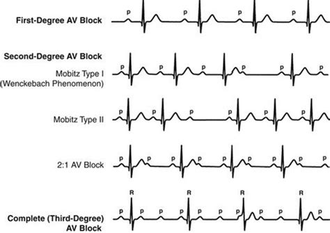 Second-Degree Heart Block: Symptoms, Causes, Treatment,, 45% OFF