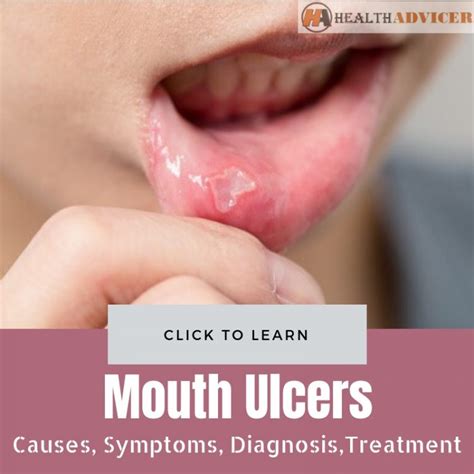 Mouth Ulcers: Causes, Picture, Symptoms, Diagnosis And Treatment