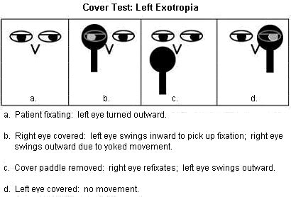 Strabismus Testing Techniques