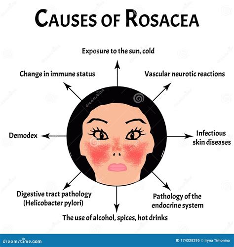 Rosacea: Causes, Types And Facts. Infographics Cartoon Vector ...