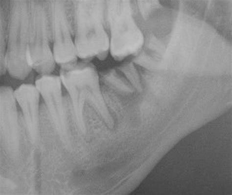 Periapical Abscess Radiograph